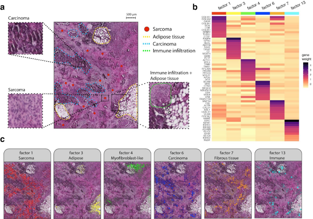 FFPE空間轉(zhuǎn)錄組解析卵巢癌肉瘤免疫浸潤過程[4]