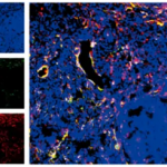 《cell reports》慢性肉芽腫病的發(fā)病機(jī)制新發(fā)現(xiàn)